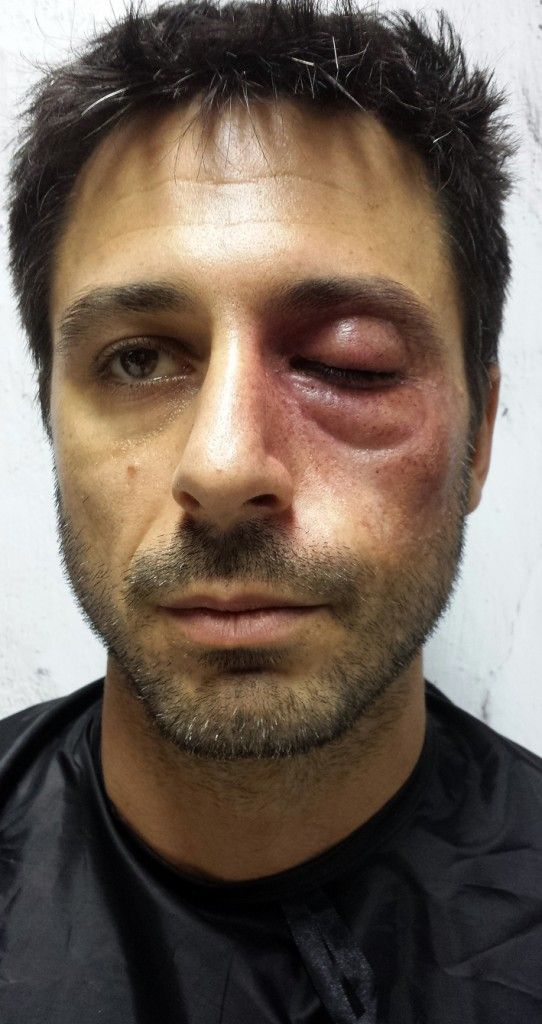 silicone-prosthetic-542×1024